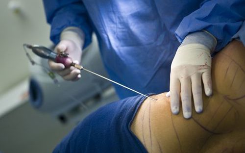 Liposuction Procedure Book an Appointment with your Doctor